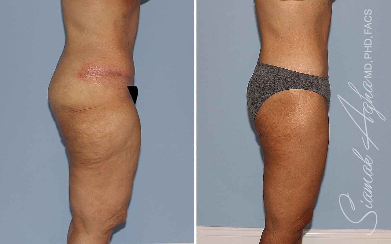 High-Definition Lower Body Lift™ Before & After