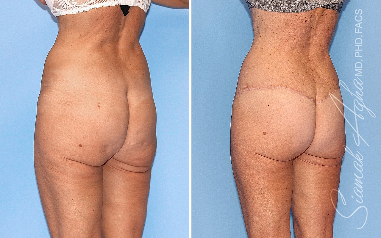 High-Definition Lower Body Lift™ Before & After