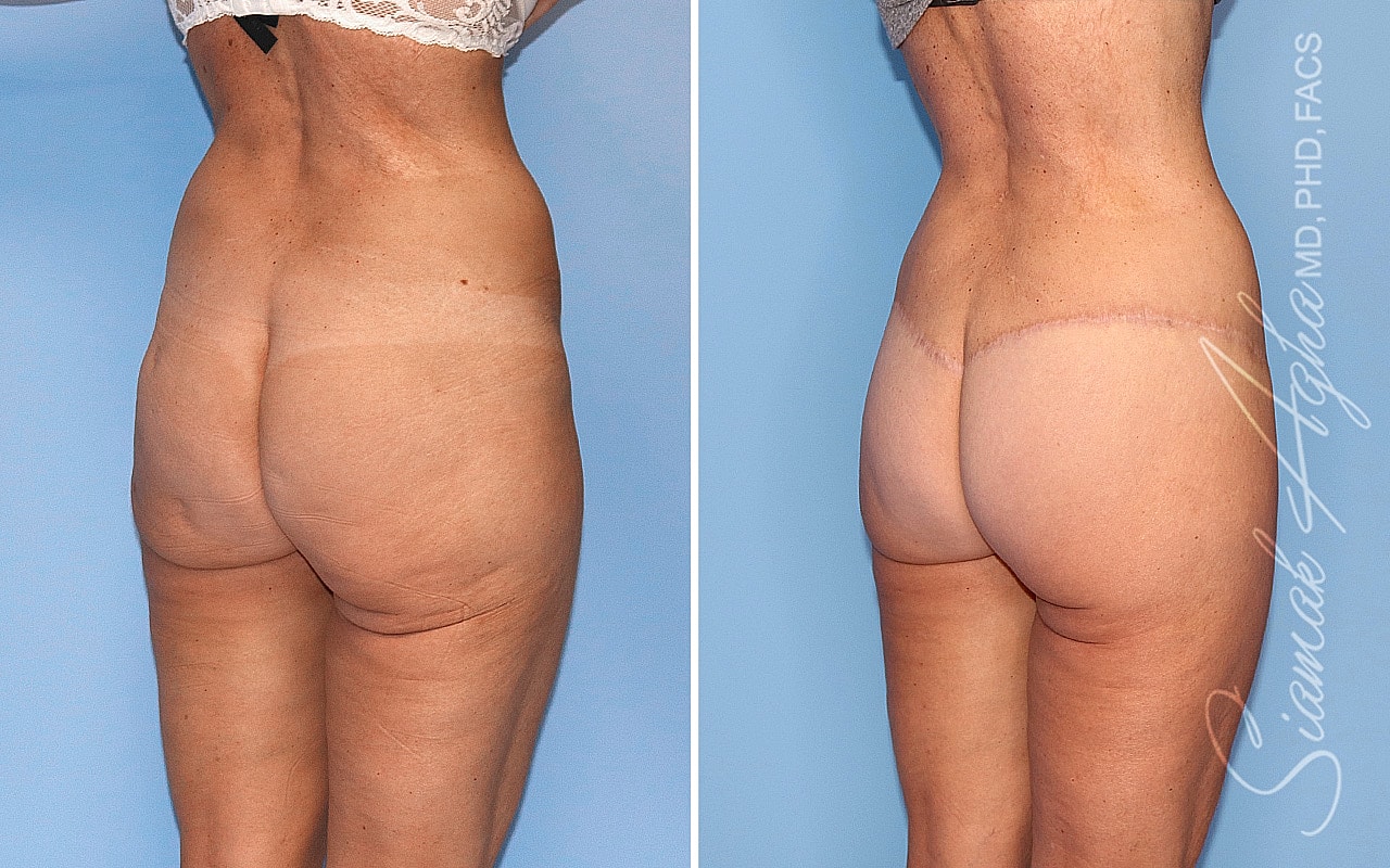 High-Definition Lower Body Lift™ Before & After
