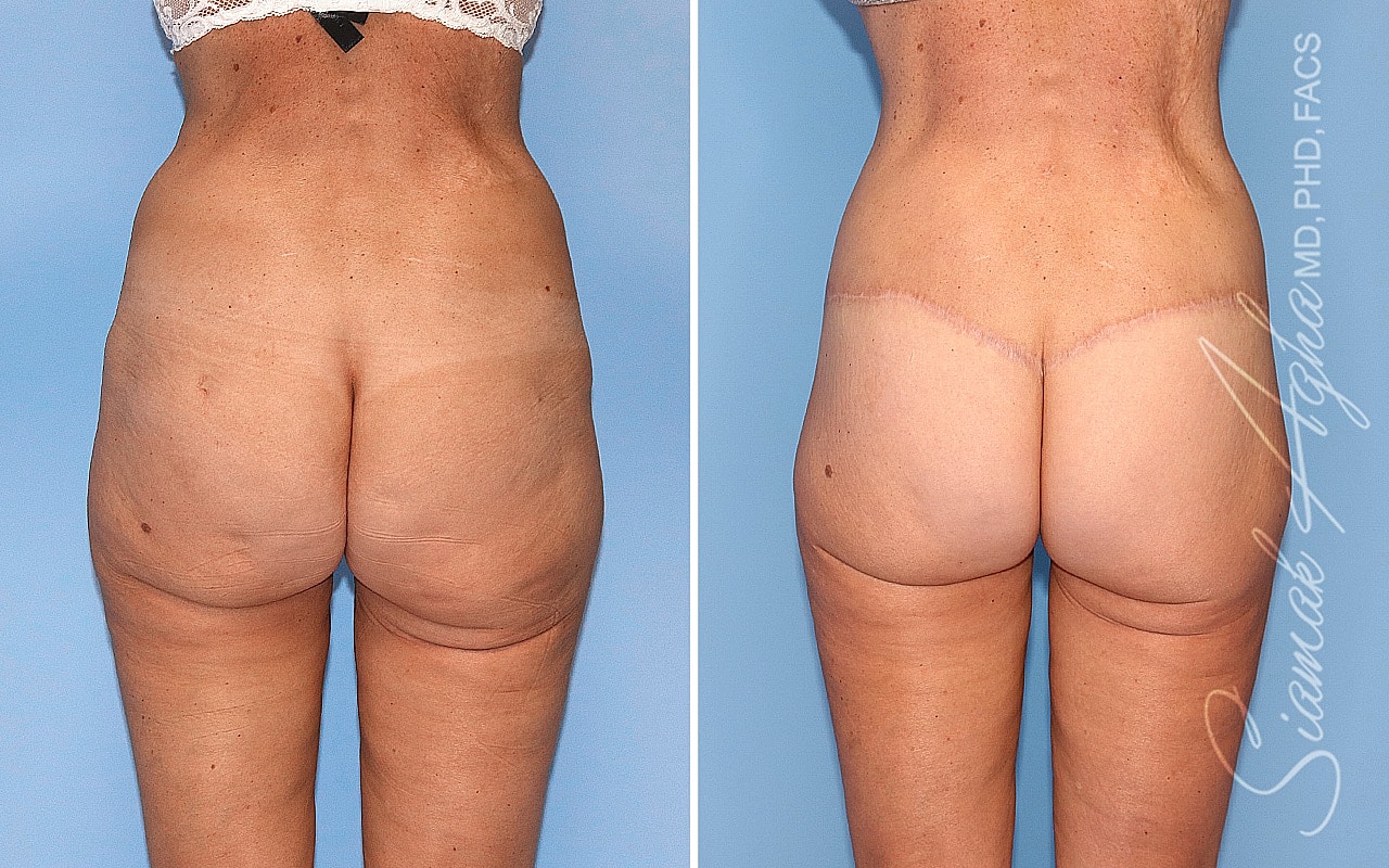 High-Definition Lower Body Lift™ Before & After
