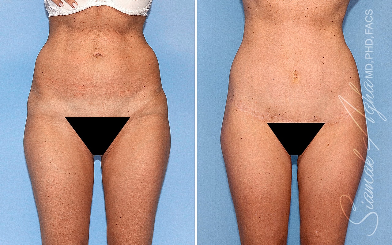 High-Definition Lower Body Lift™ Before & After