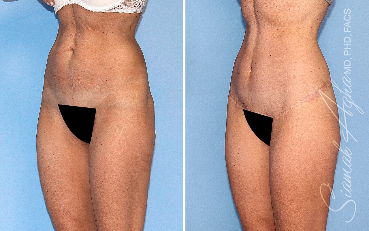 High-Definition Lower Body Lift™ Before & After