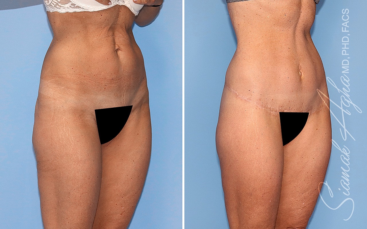 High-Definition Lower Body Lift™ Before & After
