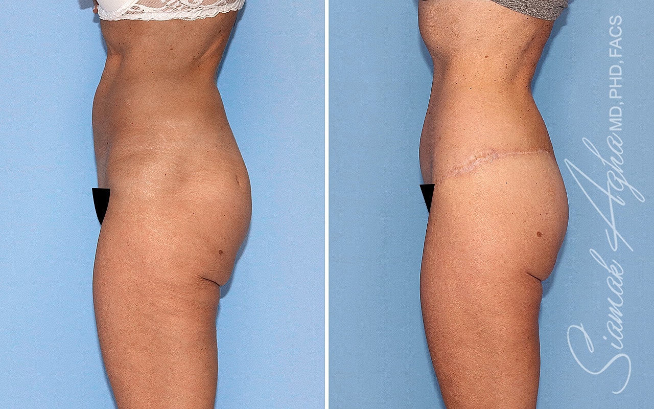 High-Definition Lower Body Lift™ Before & After