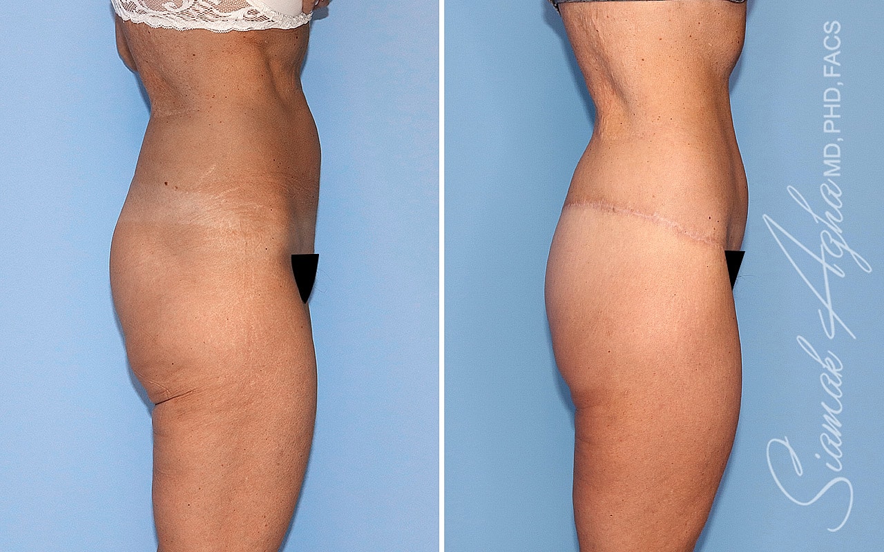High-Definition Lower Body Lift™ Before & After
