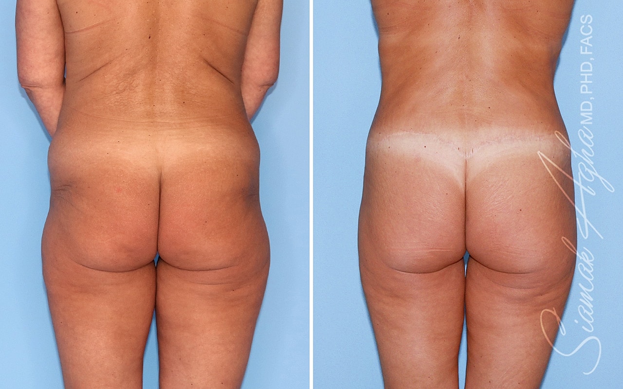 High-Definition Lower Body Lift™ Before & After