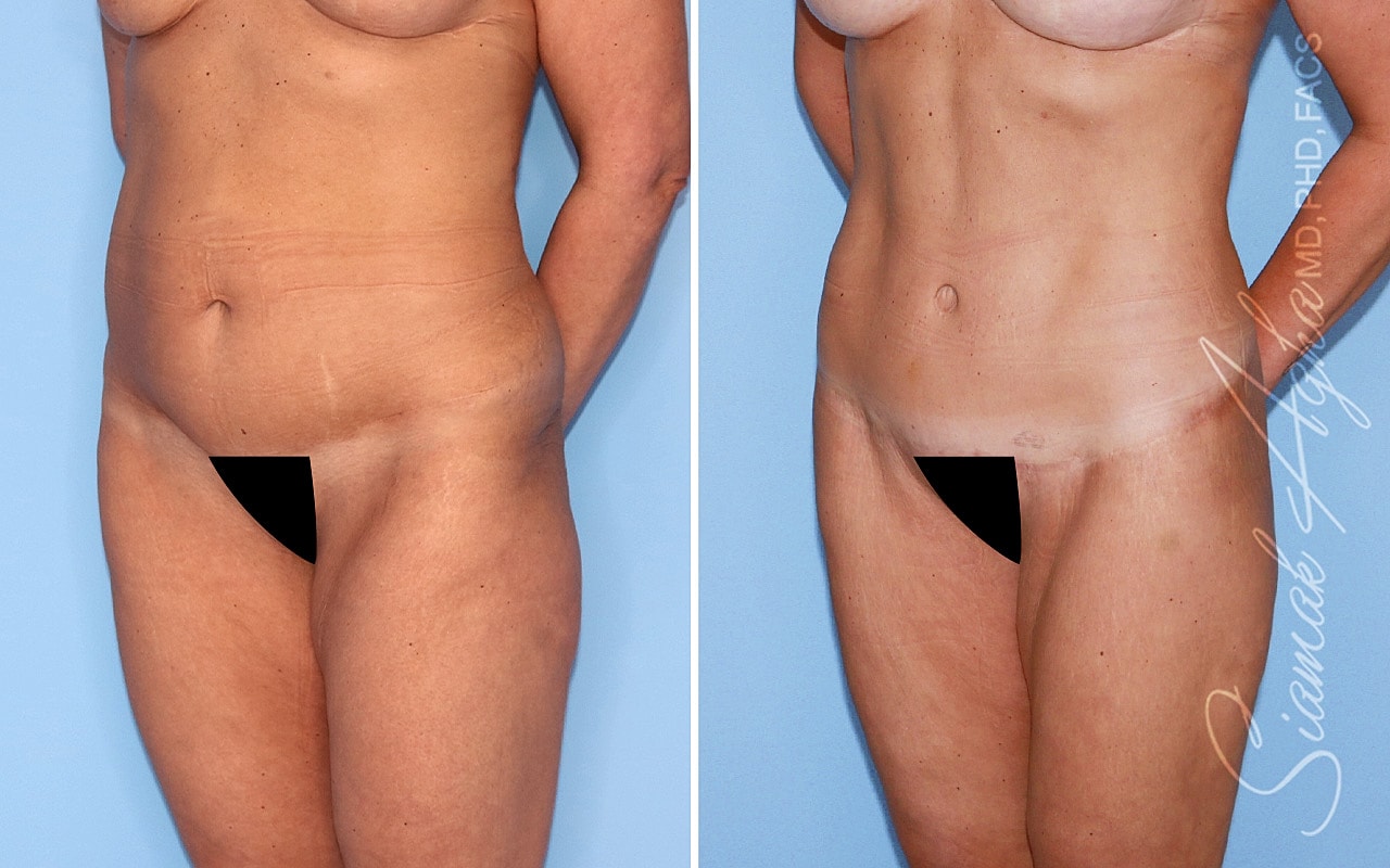 High-Definition Lower Body Lift™ Before & After