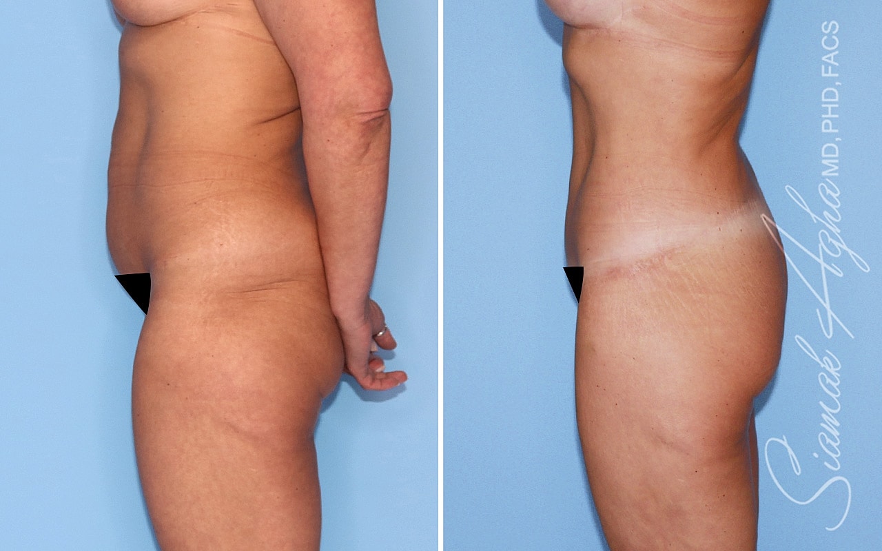 High-Definition Lower Body Lift™ Before & After