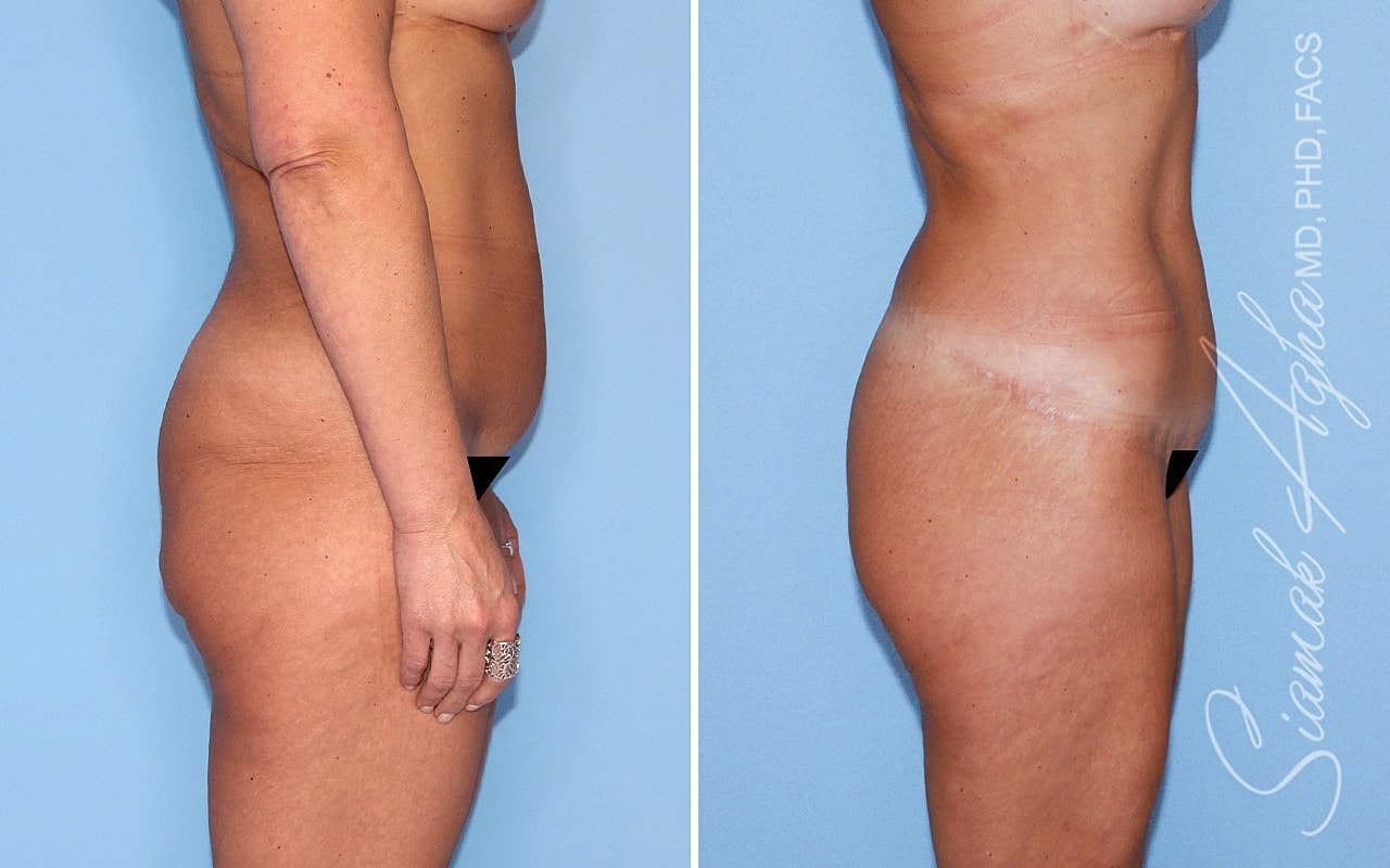 High-Definition Lower Body Lift™ Before & After