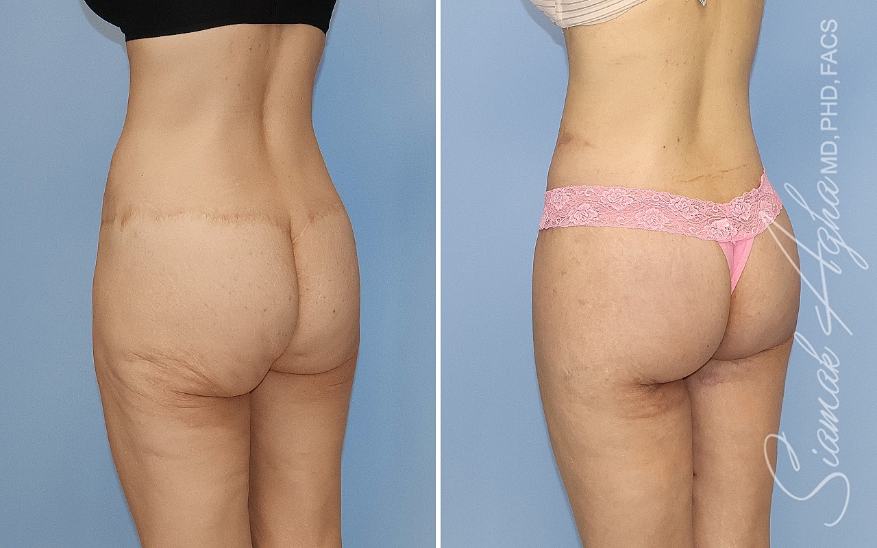 High-Definition Lower Body Lift™ Before & After