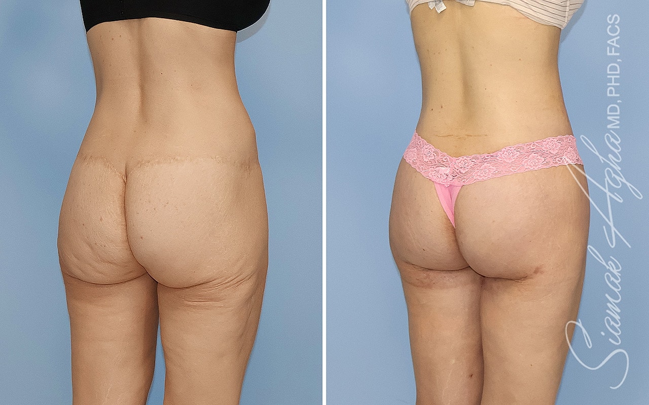 High-Definition Lower Body Lift™ Before & After