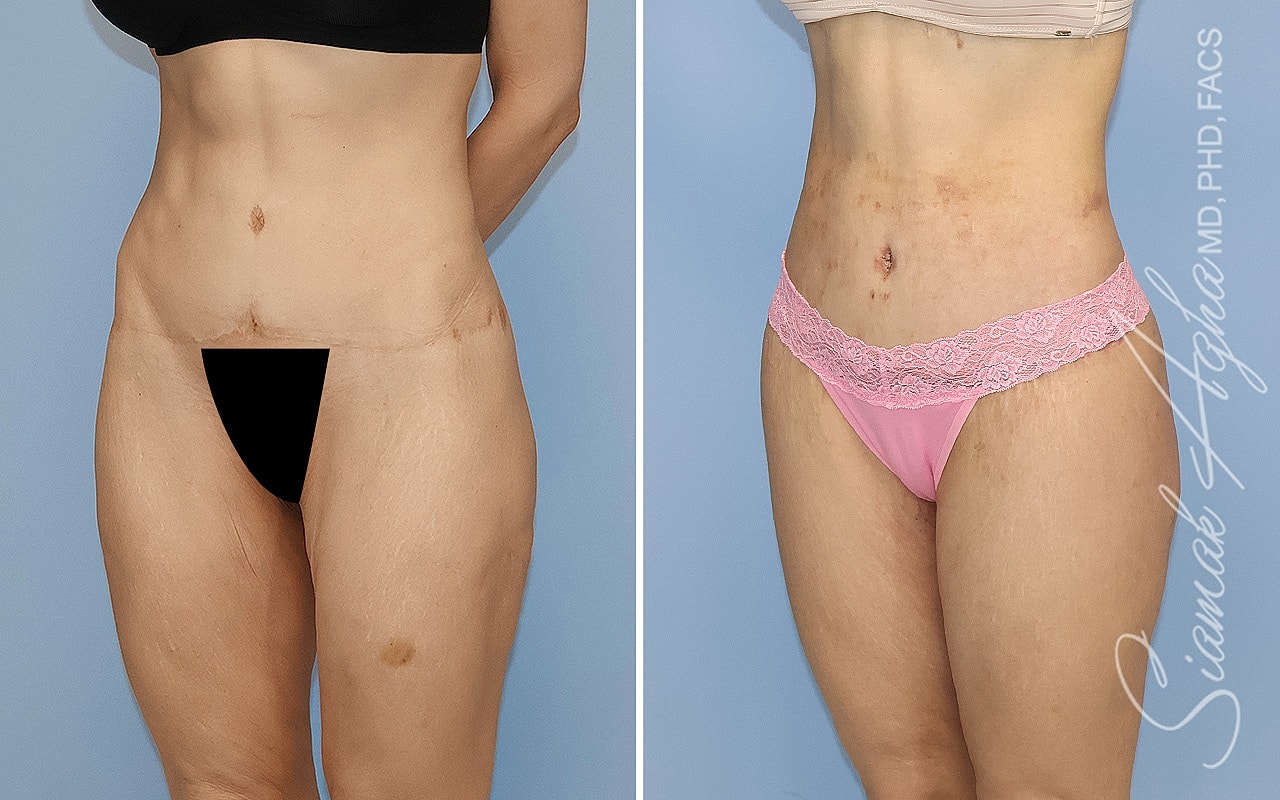 High-Definition Lower Body Lift™ Before & After
