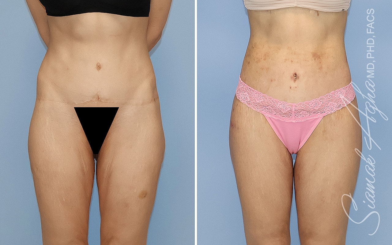 High-Definition Lower Body Lift™ Before & After