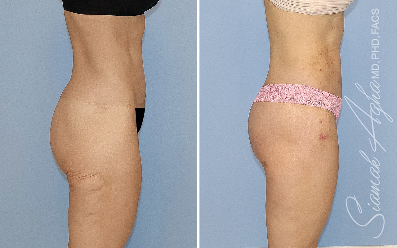 High-Definition Lower Body Lift™ Before & After