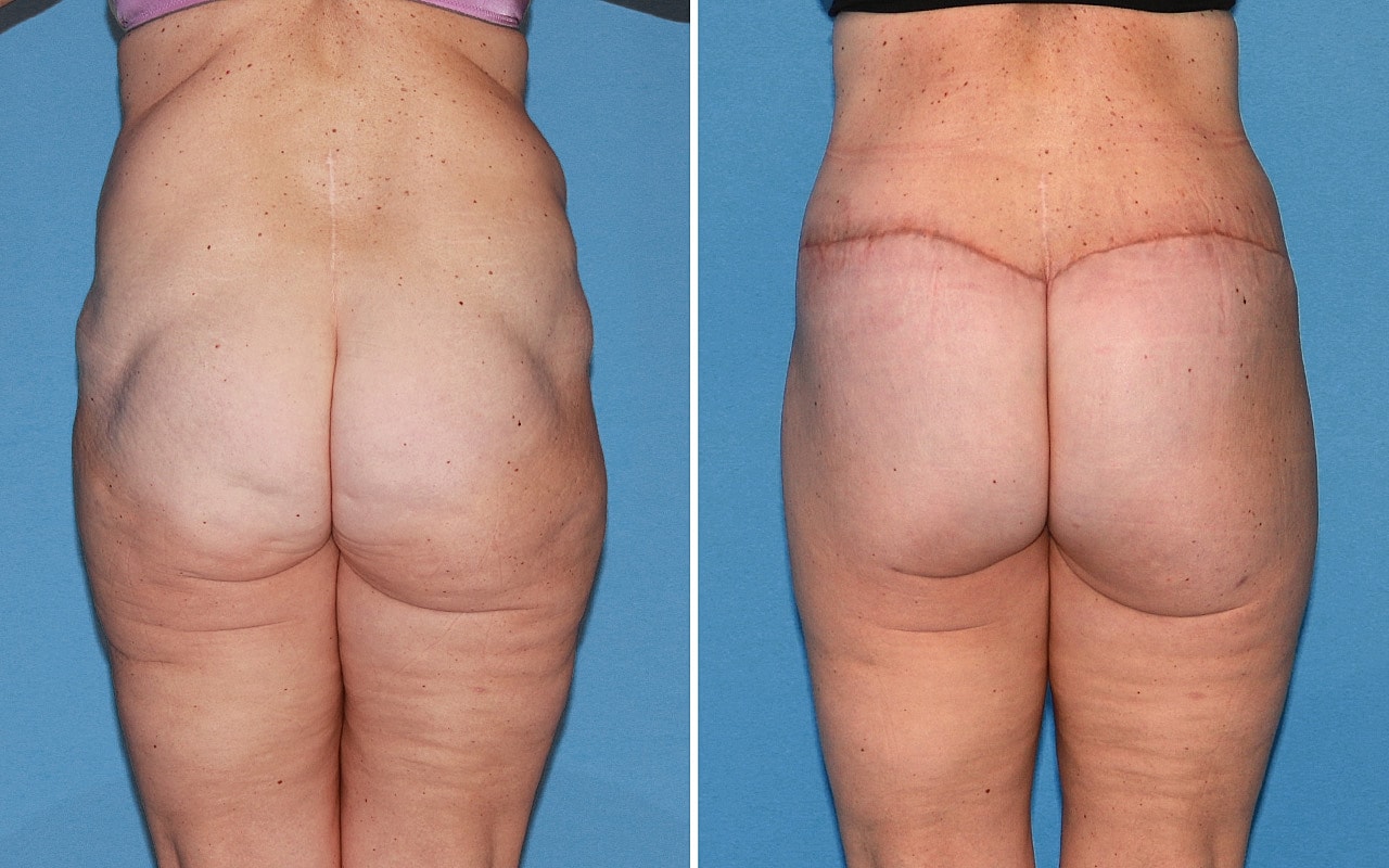 Lower Body Lift Before & After