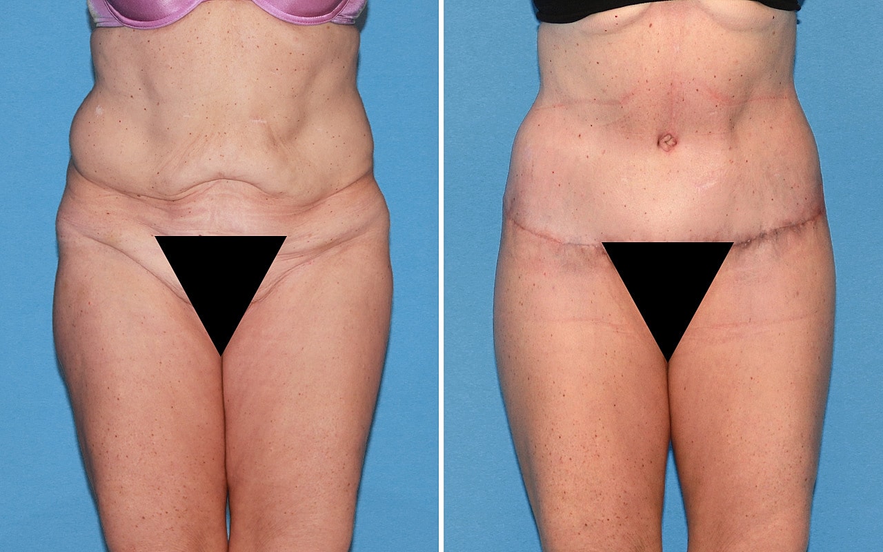 Lower Body Lift Before & After