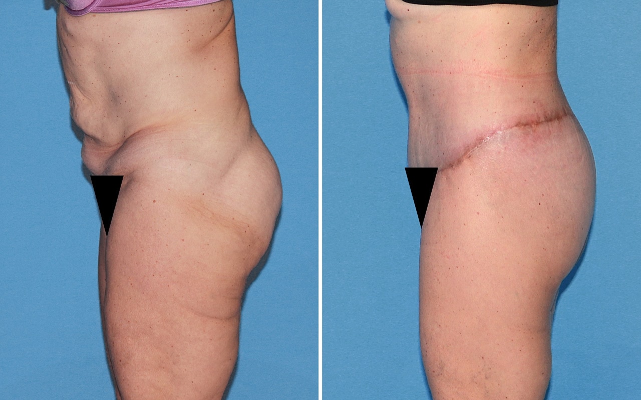 Lower Body Lift Before & After