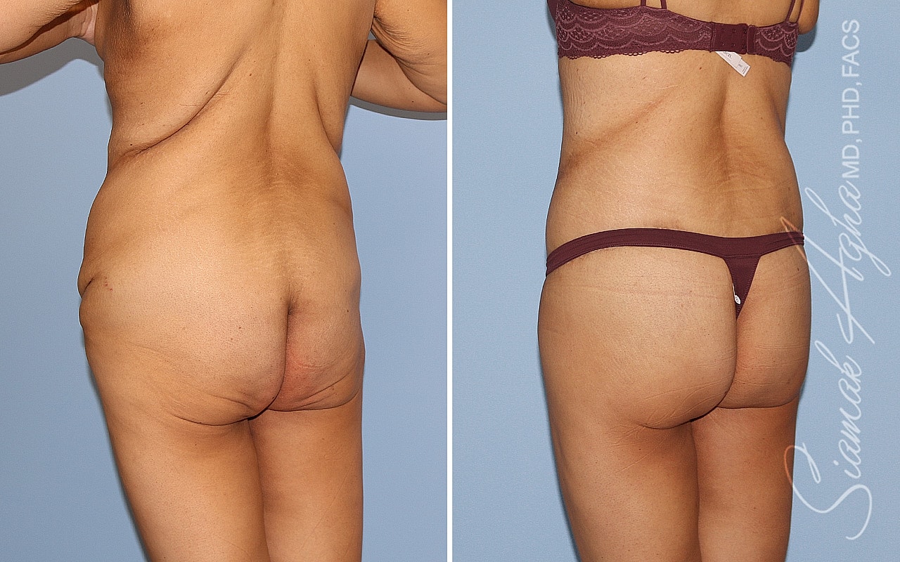 High-Definition Lower Body Lift™ Before & After