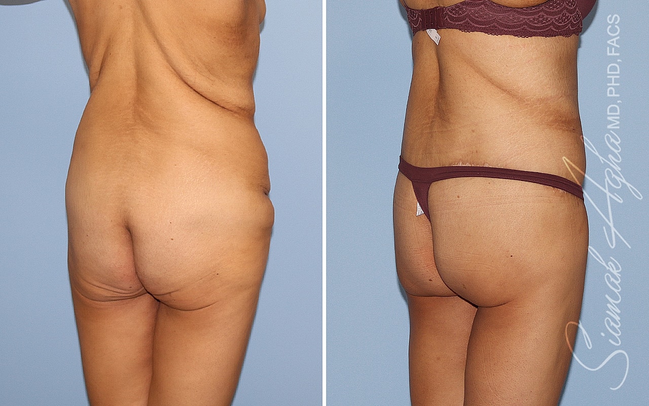 High-Definition Lower Body Lift™ Before & After