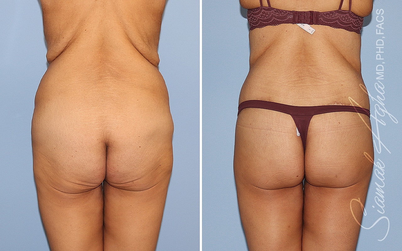High-Definition Lower Body Lift™ Before & After