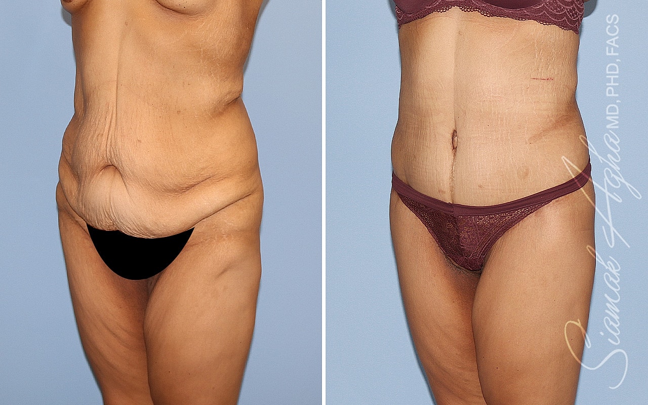 High-Definition Lower Body Lift™ Before & After