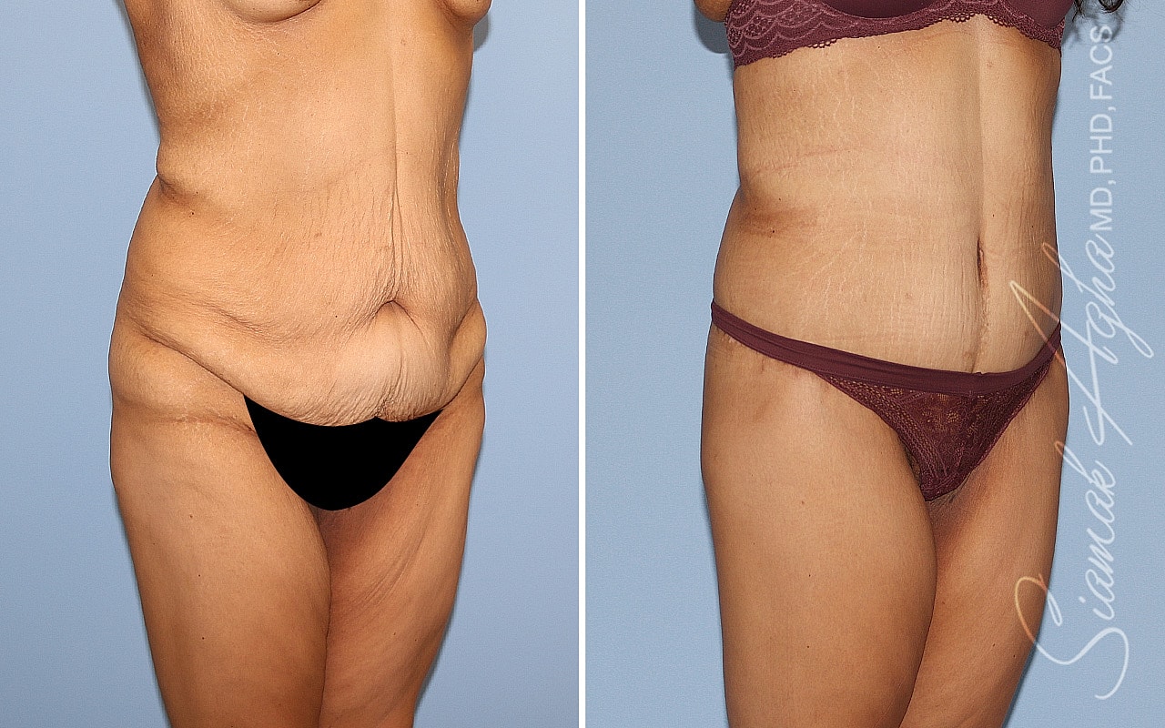 High-Definition Lower Body Lift™ Before & After