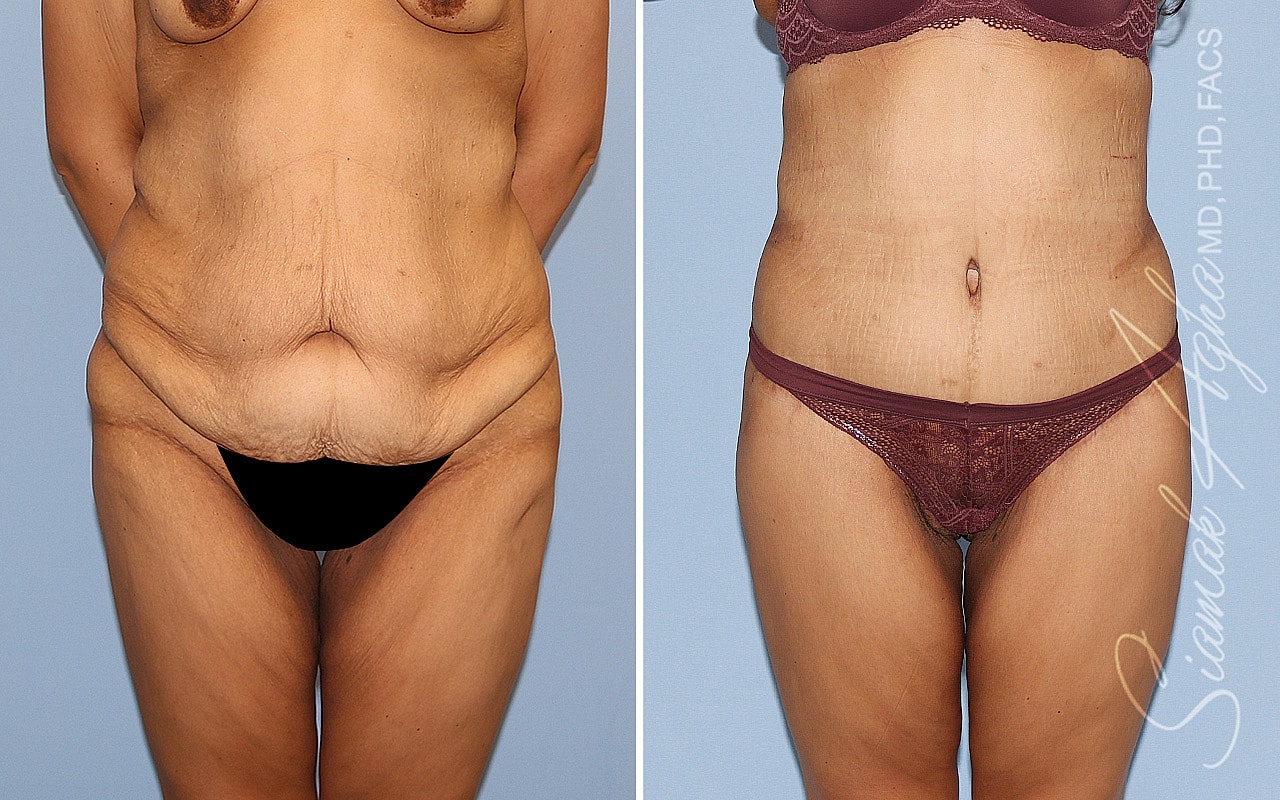 High-Definition Lower Body Lift™ Before & After