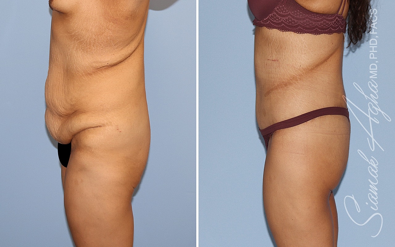 High-Definition Lower Body Lift™ Before & After