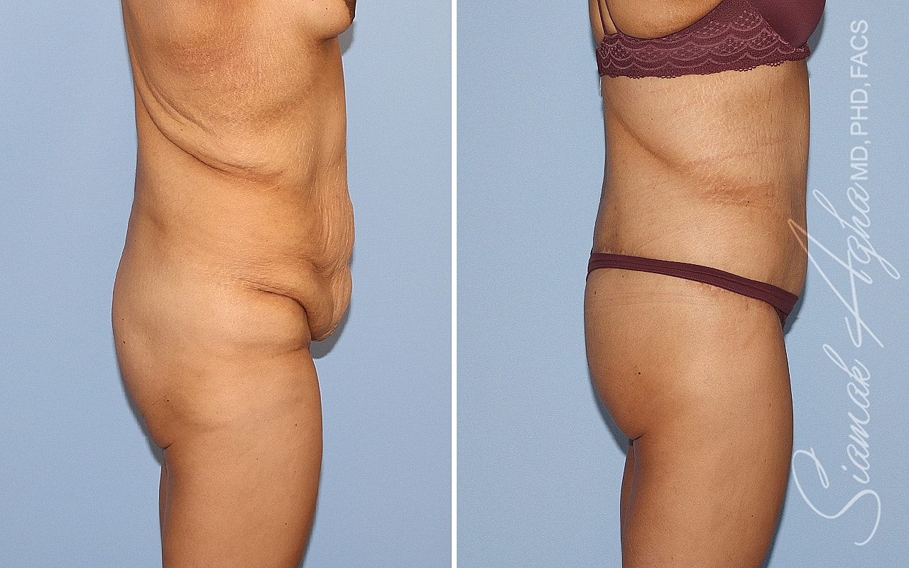 High-Definition Lower Body Lift™ Before & After