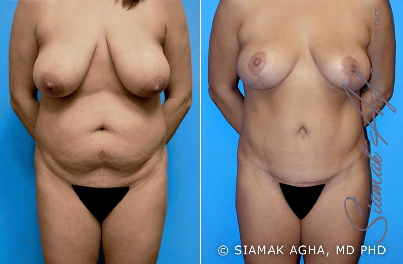 Mommy Makeover Before & After