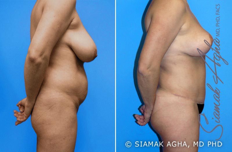 Mommy Makeover Before & After