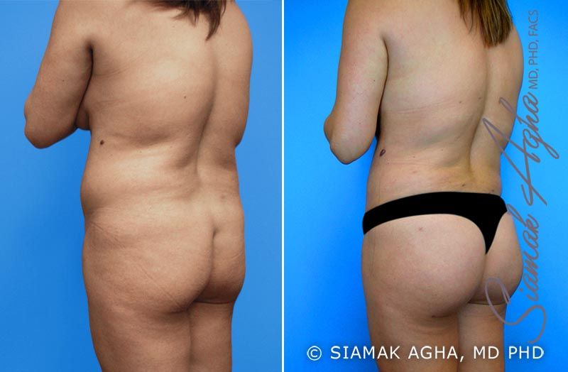 Mommy Makeover Before & After