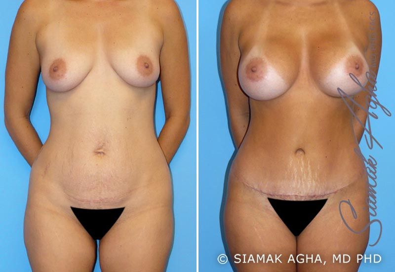 Mommy Makeover Before & After