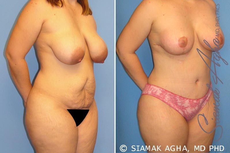 Mommy Makeover Before & After