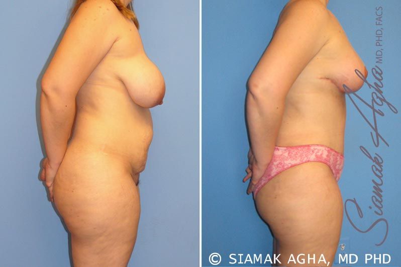 Mommy Makeover Before & After