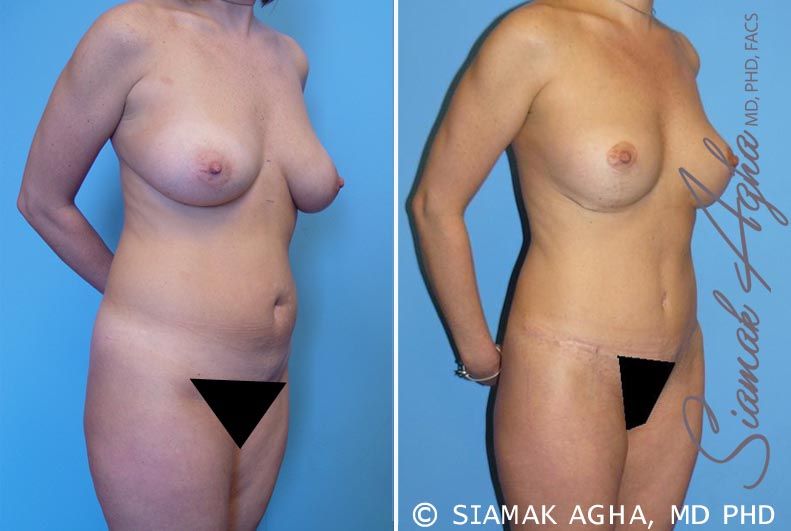 Mommy Makeover Before & After