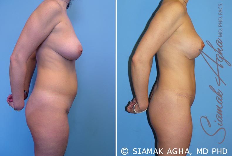 Mommy Makeover Before & After