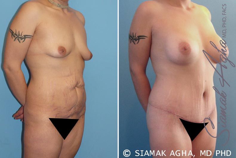 Mommy Makeover Before & After