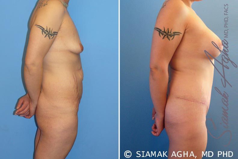 Mommy Makeover Before & After