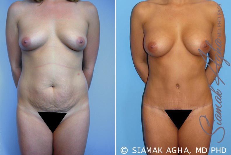 Mommy Makeover Before & After