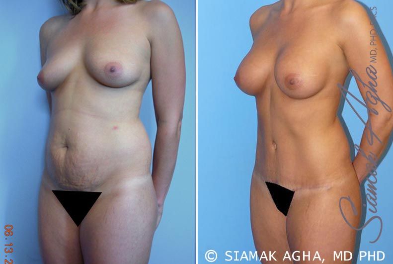 Mommy Makeover Before & After