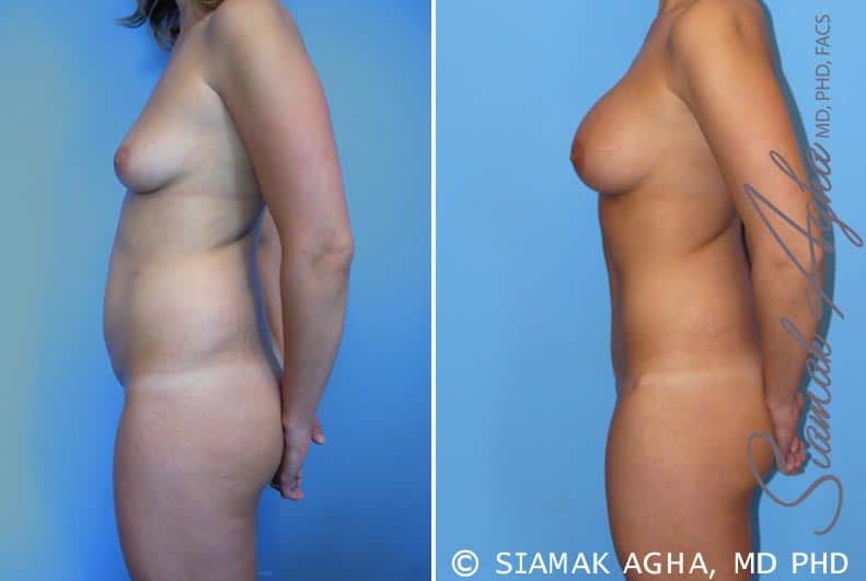 Mommy Makeover Before & After