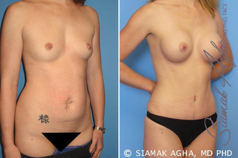 Mommy Makeover Before & After