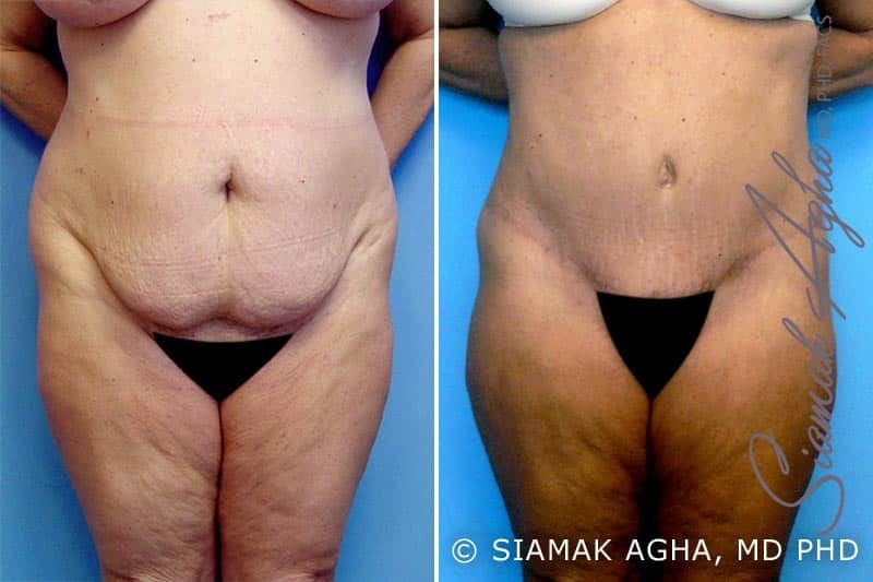 Mommy Makeover Before & After