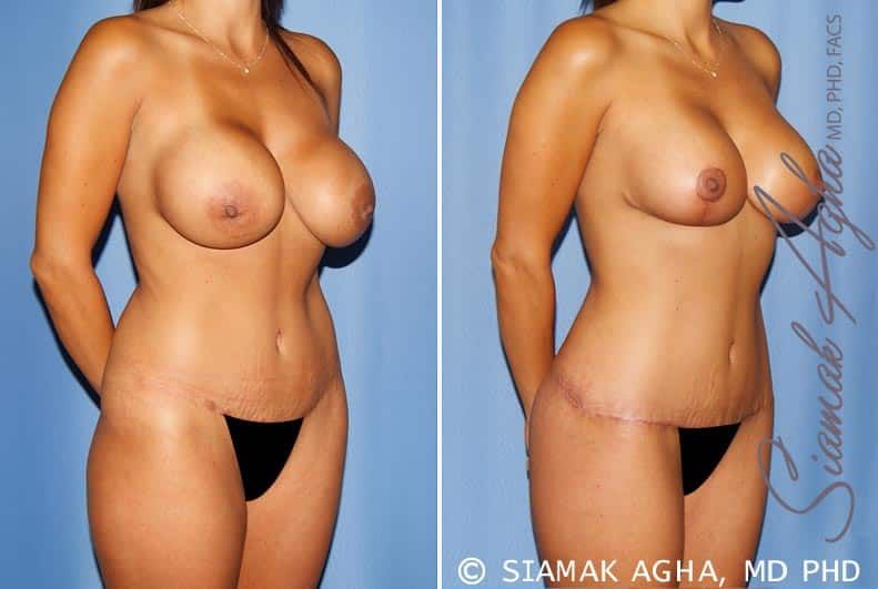 Mommy Makeover Before & After