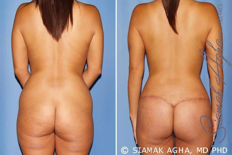 Mommy Makeover Before & After