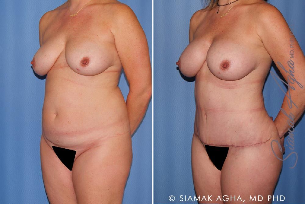 Mommy Makeover Before & After