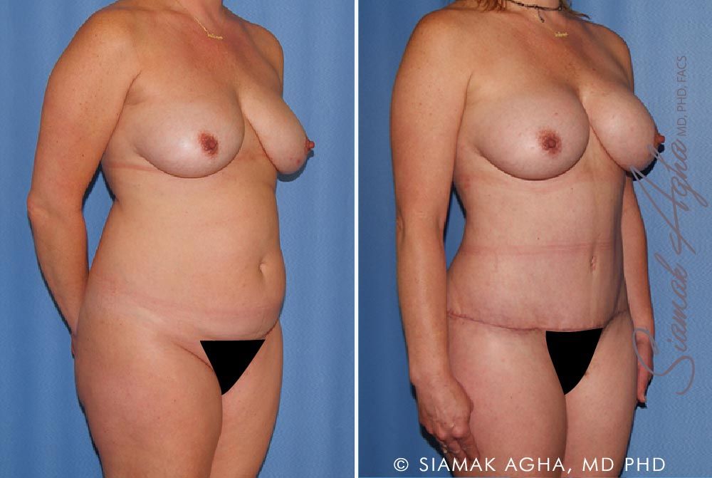 Mommy Makeover Before & After