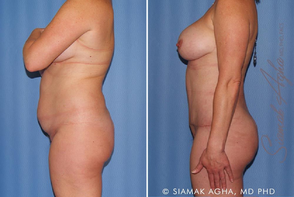 Mommy Makeover Before & After