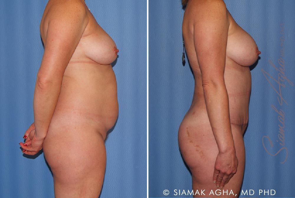 Mommy Makeover Before & After